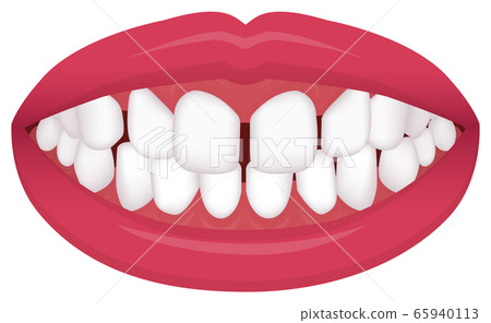 Alignment of teeth, dentition, and types of malocclusion Vector illustration / void dentition (smooth teeth) Alignment of teeth, dentition, and types of malocclusion Vector illustration / void dentition (smooth teeth) 65940113