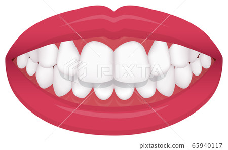 Types of dentition, dentition, malocclusion Vector illustration / Maxillary anterior protrusion (protruding tooth) 65940117