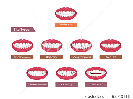 牙齒對齊 牙列 咬合不正的類型矢量插圖集 英語 插圖素材 圖庫