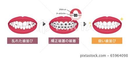 正畸/正畸過程矢量圖 65964098