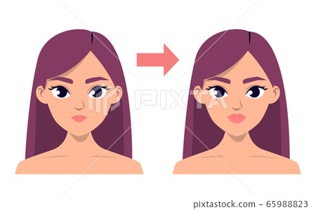 Before and after lip injection vector isolated 65988823