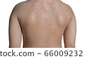 Urticaria or hives on child back with clipping 66009232