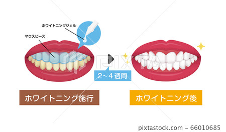 Tooth whitening (home whitening) flow vector illustration Tooth whitening (home whitening) flow vector illustration 66010685