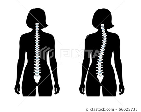 Scoliosis flat vector illustration 66025733