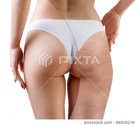 Female buttocks before and after cellulitis treatment. 66026239