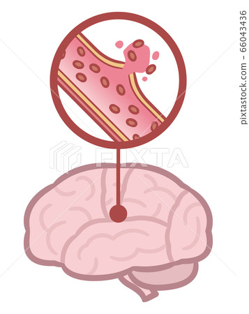 cerebral hemorrhage - Stock Illustration [66043436] - PIXTA