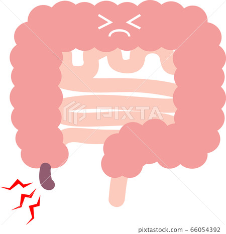 Illustration of appendicitis (cecum) visceral digestive system 66054392