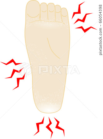 Illustration of athlete's foot itchy feet Illustration of athlete's foot itchy feet 66054398