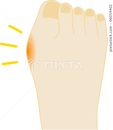 Hallux valgus painful foot illustration 66054402