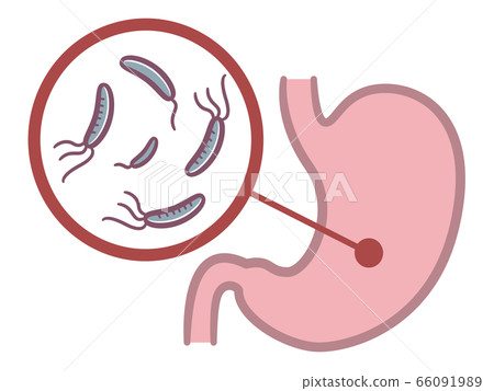 插圖顯示幽門螺桿菌潛伏在胃中 66091989