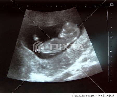 2D picture of ultrasound baby. 2D picture of ultrasound baby. 66126496