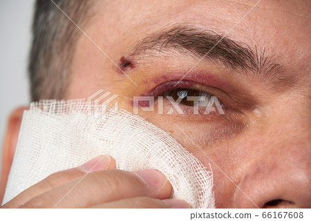close view of a bruise near the eye, the face of a close view of a bruise near the eye, the face of a 66167608