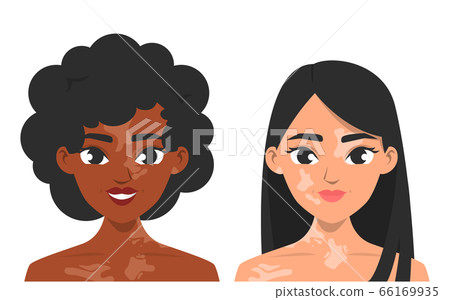 Women with vitiligo vector isolated. Skin pigmentation Women with vitiligo vector isolated. Skin pigmentation 66169935