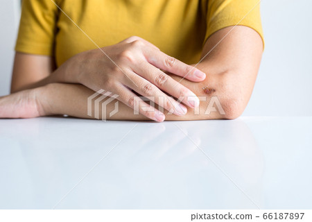 Woman showing wound on her arm,Scab Becomes Infected 66187897