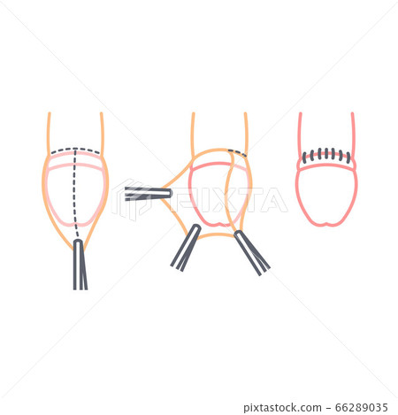 circumcision line icon, vector illustration 66289035