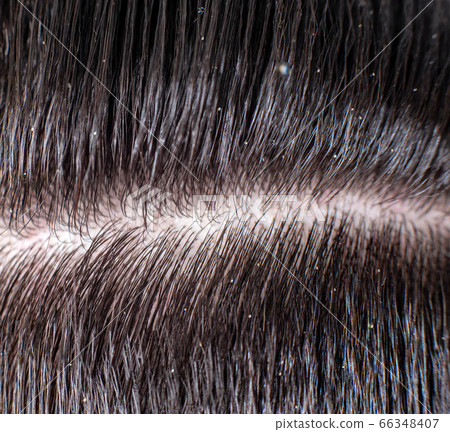 Scales of dandruff in a man's black hair. The concept of getting rid of dandruff and hair care, background, macro 66348407