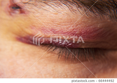 close view of a bruise near the eye, the face of a close view of a bruise near the eye, the face of a 66444492