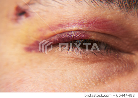 close view of a bruise near the eye, the face of a close view of a bruise near the eye, the face of a 66444498