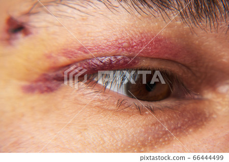 close view of a bruise near the eye, the face of a close view of a bruise near the eye, the face of a 66444499
