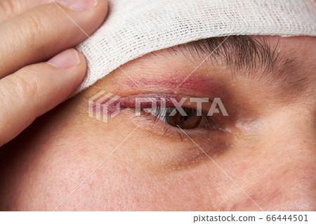 close view of a bruise near the eye, the face of a close view of a bruise near the eye, the face of a 66444501