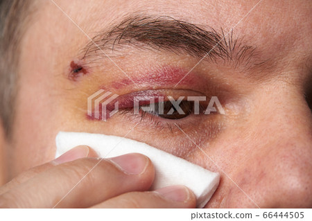 close view of a bruise near the eye, the face of a close view of a bruise near the eye, the face of a 66444505