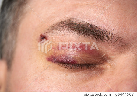 close view of a bruise near the eye, the face of a close view of a bruise near the eye, the face of a 66444508