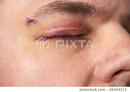 close view of a bruise near the eye, the face of a close view of a bruise near the eye, the face of a 66444515