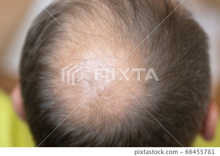 Hair losing concept. Close up view of a man's head. Hair losing concept. Close up view of a man's head. 66455781