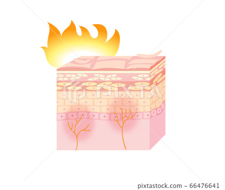 皮膚發炎的插圖 皮膚發炎的插圖 66476641