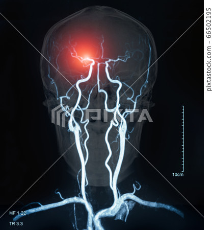 brain stroke brain stroke 66502195