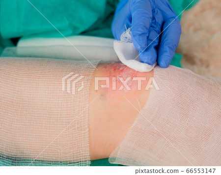 Disinfection of a bleeding graze on the knee of a teenage girl with an antiseptic. Disinfection of a bleeding graze on the knee of a teenage girl with an antiseptic. 66553147