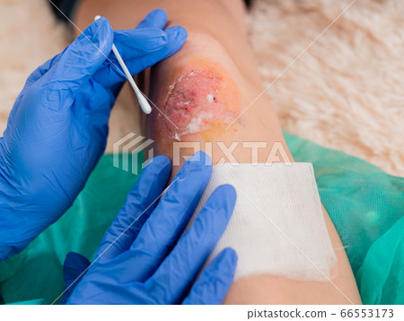 Close-up, treatment of an abrasion on the knee of a teenage girl by a doctor. Close-up, treatment of an abrasion on the knee of a teenage girl by a doctor. 66553173