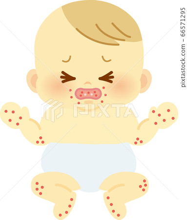 患有手足口病的嬰兒_嬰兒全身插圖24 66571295