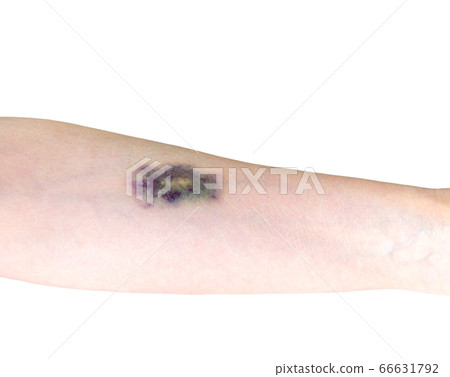 藍色青腫的手臂，紫癜，出血，瘀傷，瘀傷 66631792
