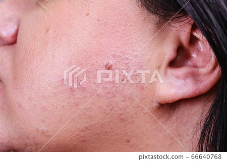 Skin face after removing hair Skin face after removing hair 66640768