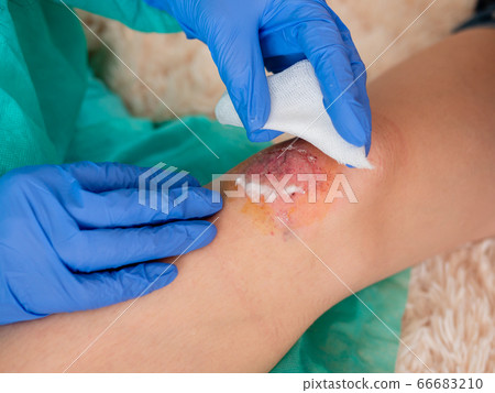 A doctor uses hydrogen peroxide to treat an abrasion on a teenage girl's knee. 66683210