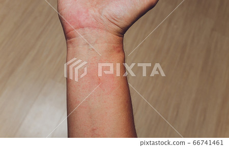 Red blisters on the hand and dermatitis, itching from allergies, skin diseases or insects, poisonous animals bite. 66741461