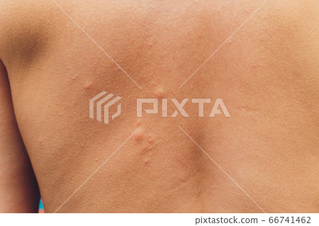 a man's back bite of a mosquito on the background of a mall. a man's back bite of a mosquito on the background of a mall. 66741462