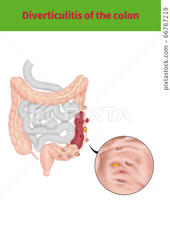 結腸憩室炎醫學插圖 66767219