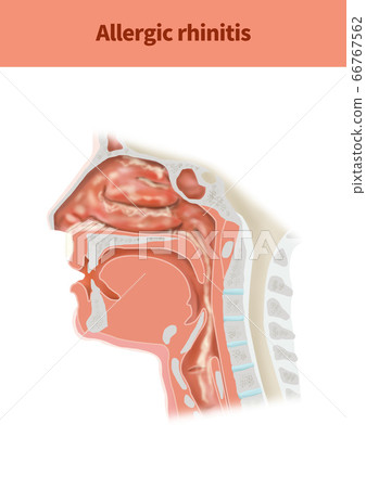 Rhinitis medical illustration - Stock Illustration [66767562] - PIXTA