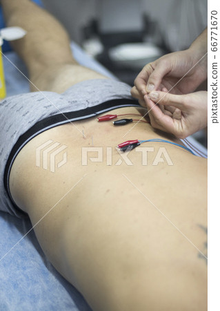 EPI dry needling physiotherapy 66771670