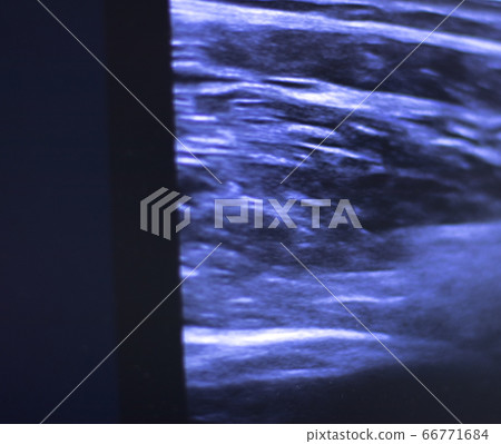 EPI dry needling ultrasound scan EPI dry needling ultrasound scan 66771684