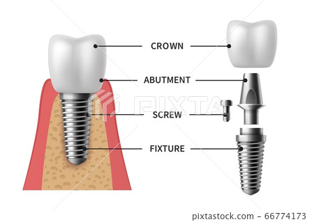 Tooth implant. Realistic implant structure pictorial models crown. Abutment, screw denture orthodontic implantation teeth vector set 66774173