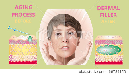 Cosmetic filler or dermal fillers Cosmetic filler or dermal fillers 66784153