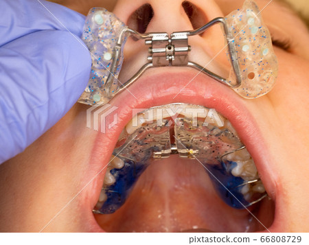 View of child jaw with braces installed to tooth. View of child jaw with braces installed to tooth. 66808729