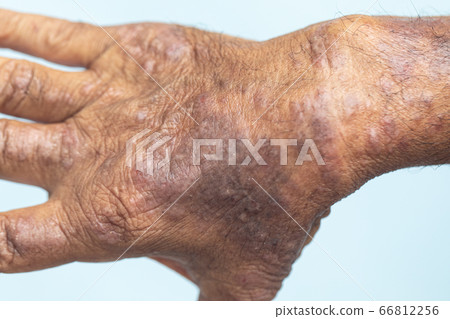 A physical of Atopic dermatitis (AD), also known as atopic eczema, is a type of inflammation of the skin (dermatitis). A physical of Atopic dermatitis (AD), also known as atopic eczema, is a type of inflammation of the skin (dermatitis). 66812256