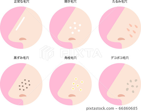 Nose pore symptoms set 66860685