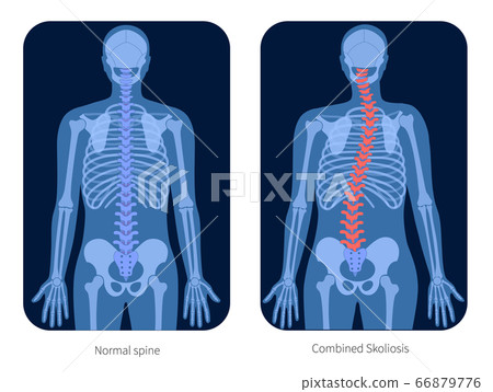 Skeleton x ray - Stock Illustration [66879776] - PIXTA