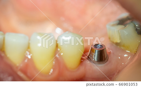 Profile view of implant in the lower part Profile view of implant in the lower part 66901053