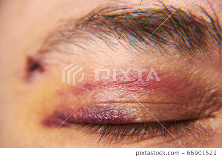 close view of a bruise near the eye, the face of a close view of a bruise near the eye, the face of a 66901521